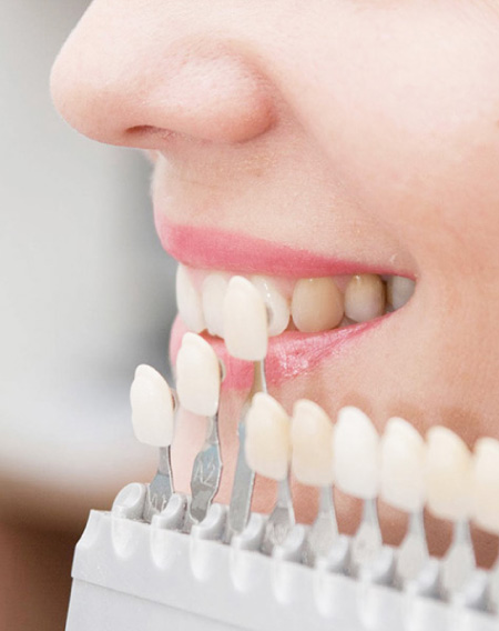 Facetas dentárias
